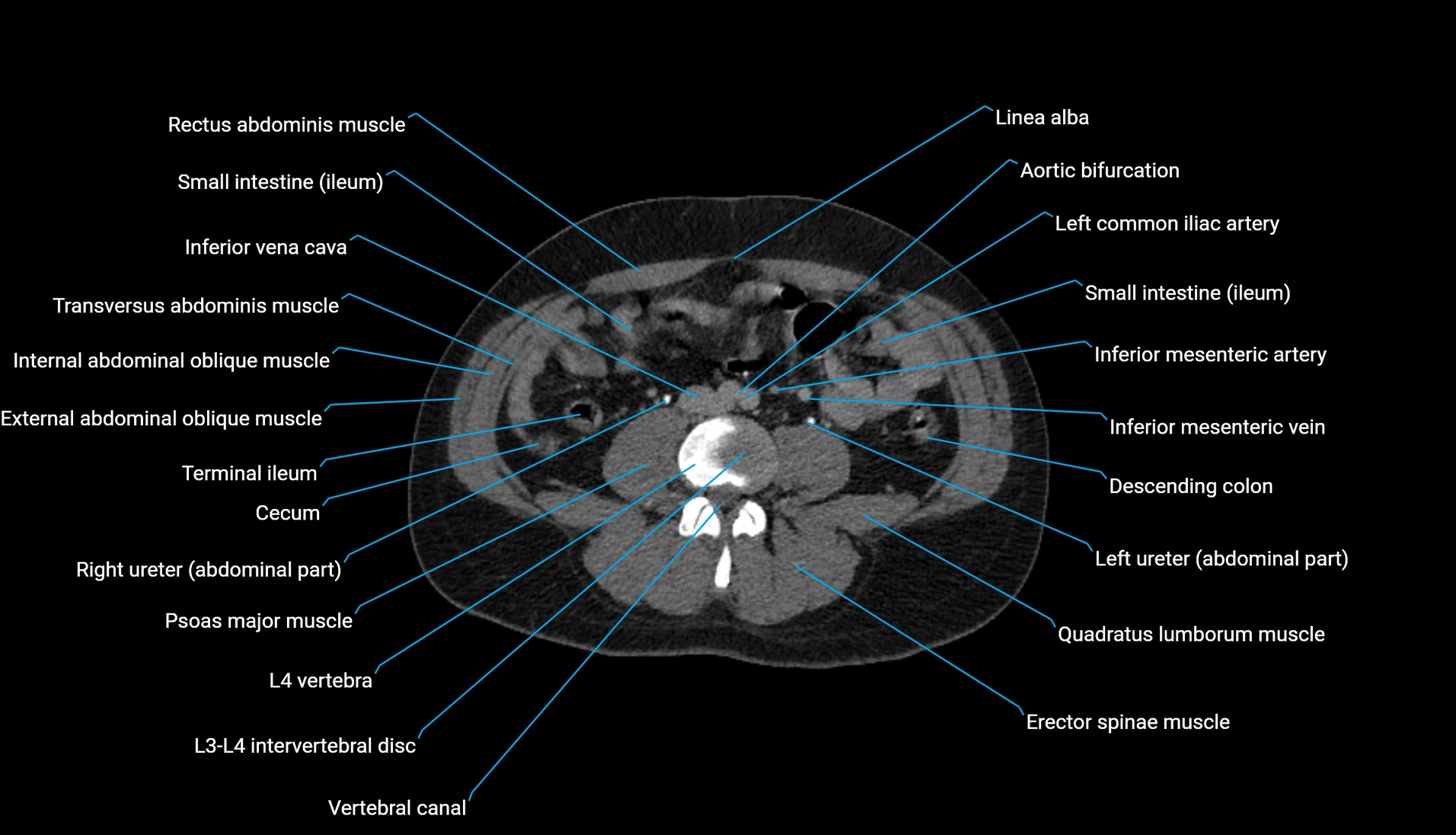 CT urogram axial cross sectional anatomy  labelled radiology image-00145.webp